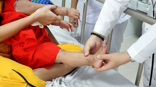 Hà Nội mở đợt cao điểm phòng chống bệnh tay chân miệng trong trường học