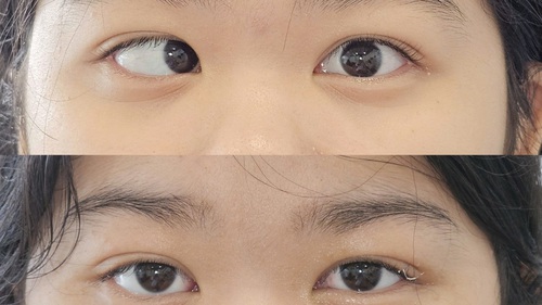 Lác (lé) mắt - có thể điều trị được không?