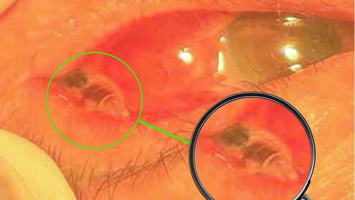 Phát hiện con ong bị kẹt trong mắt bệnh nhân hơn 24 giờ