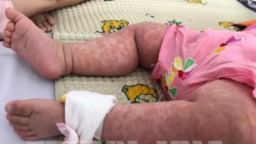 UNICEF: Dịch sởi bùng phát toàn cầu là mối đe dọa nghiêm trọng đối với trẻ em