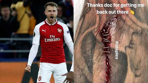 Aaron Ramsey phải vá chân bằng... ghim khi ghi bàn trước CSKA Moskva