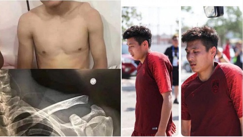 Choáng với chấn thương của ngôi sao số 1 của Trung Quốc