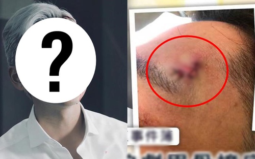 Sau 'nam thần thanh xuân' Kha Chấn Đông, thêm 1 mỹ nam có nguy cơ bị 'hủy dung' vì tai nạn phim trường nghiêm trọng!