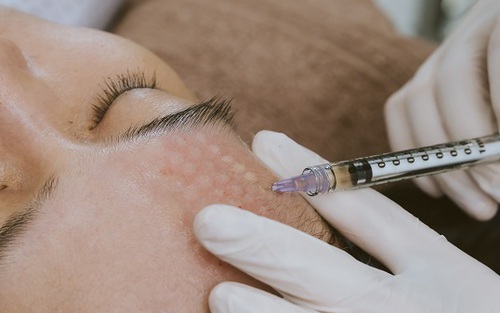 Cuối năm có 1 hình thức làm đẹp siêu hot vì hiệu quả nhanh, ít xâm lấn, chị em quan tâm nhất định phải nắm rõ những điều này