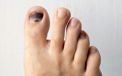 Người gan kém thường gặp 3 vấn đề này ở bàn chân, mong rằng bạn không có dù chỉ là 1 điểm