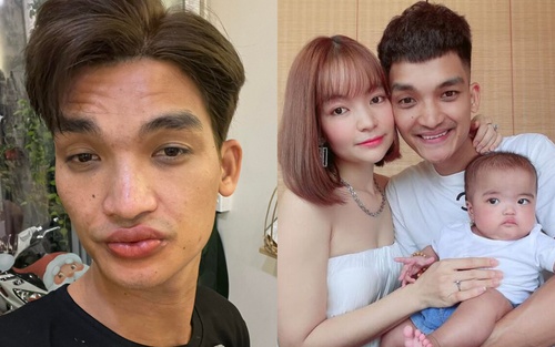 Mạc Văn Khoa bị sưng tấy môi vì làm đẹp để đóng phim, về nhà con gái không nhận ra