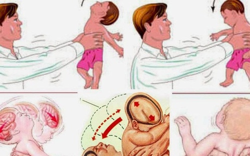 Cứu sống bé trai 4 tháng tuổi xuất huyết não do bị người thân bế xốc, rung lắc mạnh