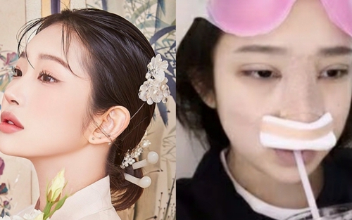 Con gái nữ minh tinh quá cố Choi Jin Sil công bố loạt ảnh ngay sau khi phẫu thuật thẩm mỹ: Bày tỏ sự hối hận?