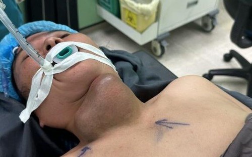 Người phụ nữ bị áp xe tuyến giáp vì tự đắp thuốc nam