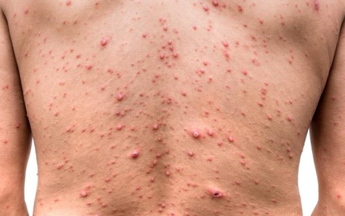Số ca thủy đậu ở Hà Nội tăng cao, chuyên gia chỉ cách phòng tránh