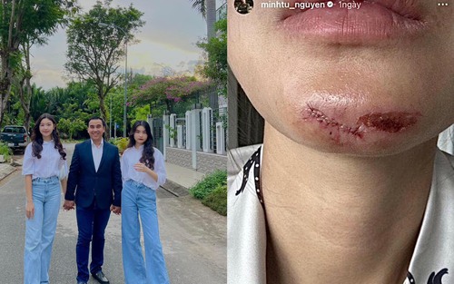 Sao Việt 19/6: Mạnh Trường, Quyền Linh khoe con gái, Minh Tú bị rách cằm khi đi làm