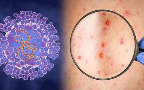 Những điều cần biết về đậu mùa khỉ mà WHO vừa ban bố trạng khẩn cấp