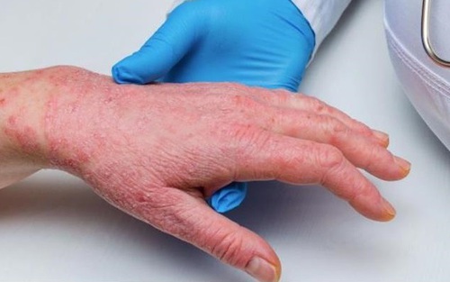 CDC châu Phi kêu gọi hành động khẩn cấp ngăn bệnh đậu mùa khỉ lây lan