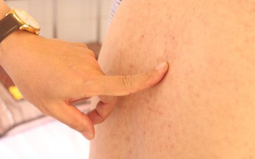 Ghi nhận bệnh Sởi ở nhiều người trưởng thành, đã có ca tử vong