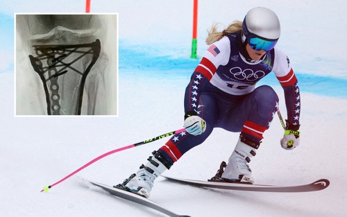 'Nữ hoàng trượt tuyết' Lindsey Vonn công bố hình ảnh X-quang kinh hoàng sau 5 ca phẫu thuật vì cú ngã ở Olympic mùa Đông
