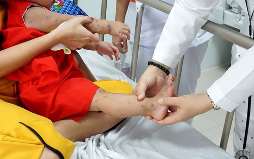 Hà Nội mở đợt cao điểm phòng chống bệnh tay chân miệng trong trường học