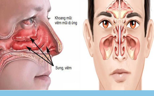 Thời tiết hè thất thường: Coi chừng nhầm lẫn giữa viêm mũi dị ứng và viêm xoang