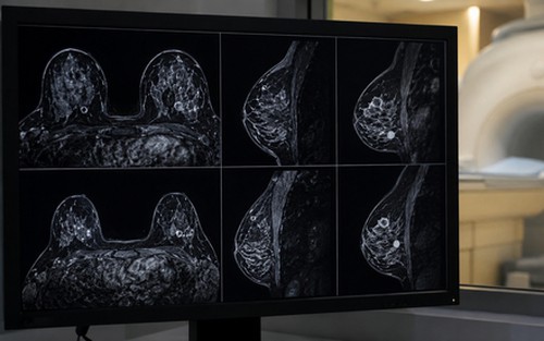 AI giúp tăng tốc chụp MRI phát hiện ung thư vú