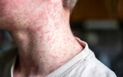 Anh ghi nhận ca tử vong đầu tiên ở người lớn do mắc sởi