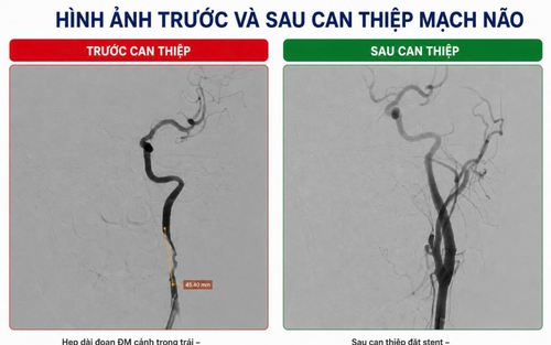 Nhồi máu não cấp sau khi chơi bóng đá do tổn thương động mạch cảnh