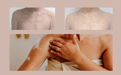 Bệnh vảy cá bẩm sinh và những hệ lụy khi lơ là chăm sóc da