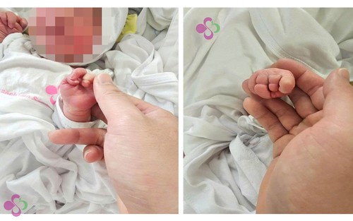 Phẫu thuật cứu cẳng chân bé sơ sinh 12 giờ tuổi bị dải sợi ối thắt nghẹt