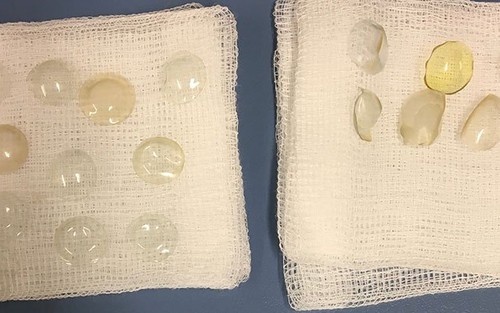 27 miếng kính áp tròng đã 'chui' vào mắt bệnh nhân thế nào?