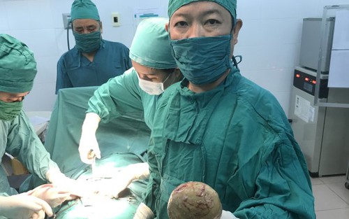 Lấy thành công viên sỏi gần nửa kg khỏi bàng quang bệnh nhân