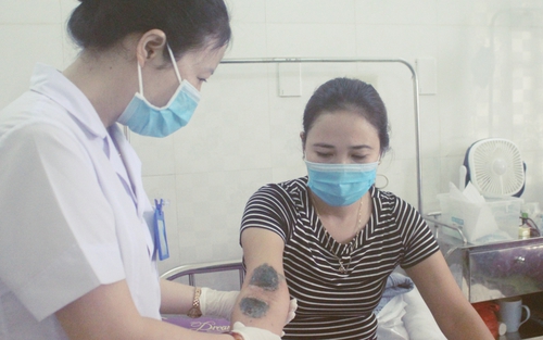 Hà Nội: Số người viêm da nặng do tiếp xúc với kiến ba khoang tăng mạnh