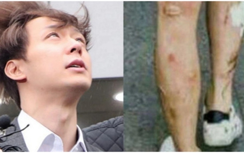 Rùng mình nhìn những vết loét, sưng rộp trên chân tay của Park Yoo Chun, hậu quả của nghiện ma túy đá