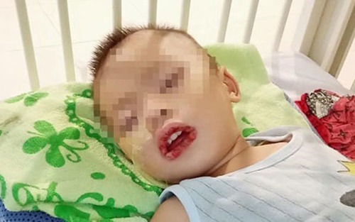 Uống nhầm thuốc tẩy bồn cầu, bé trai bị loét thực quản, dạ dày