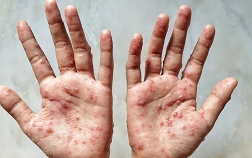 Hà Nội sẵn sàng đáp ứng khi có ca bệnh nghi ngờ đậu mùa khỉ