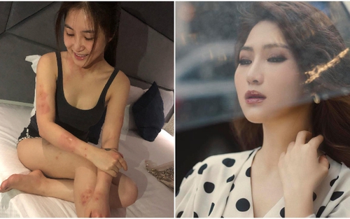 Hương Tràm bị buộc nghỉ hát vì dị ứng cấp tính, nổi mẩn khắp người