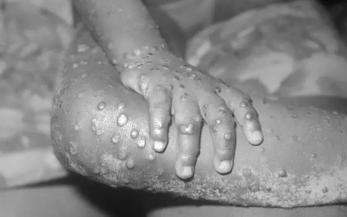 Giám sát chặt chẽ để ngăn ngừa bệnh đậu mùa khỉ xâm nhập