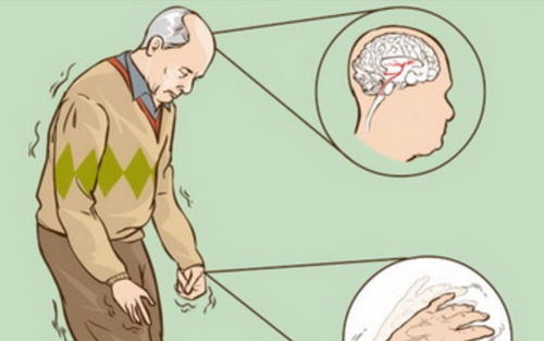 Các nhà khoa học Bỉ giải mã thành công bệnh Parkinson