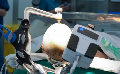 Vinmec tiên phong điều trị động kinh bằng Robot định vị thần kinh hàng đầu thế giới