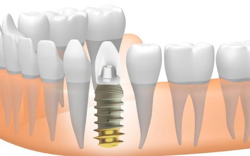 Trồng răng implant có gây đau hay xảy ra biến chứng?