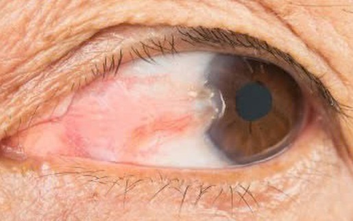 Những điều cần biết về bệnh mộng thịt