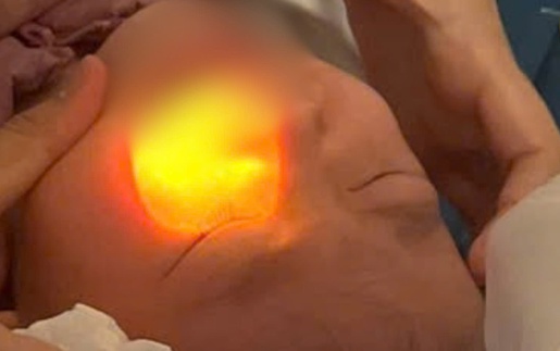 Bé gái 4 tuổi bỏng mắt vì cồn rửa tay khi đi du lịch ở Đà Lạt