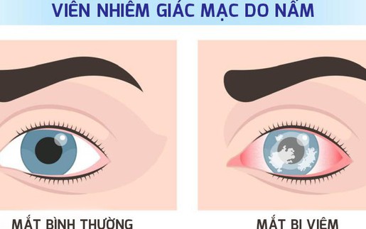 Viêm loét giác mạc do nấm - hiểm họa âm thầm có thể gây mù lòa