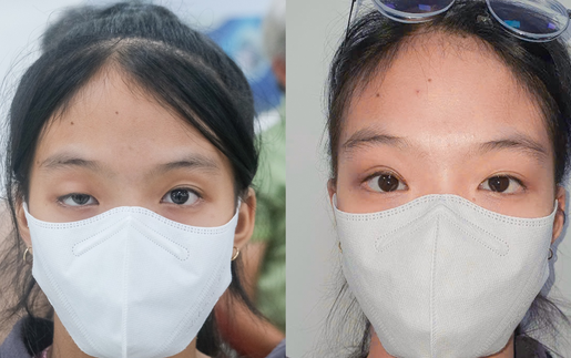 Phẫu thuật sụp mi bẩm sinh thành công, bé gái lấy lại ánh nhìn trước thềm lớp 9