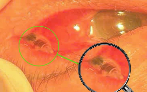 Phát hiện con ong bị kẹt trong mắt bệnh nhân hơn 24 giờ