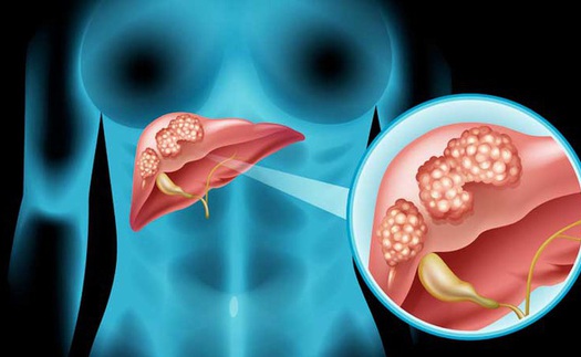 Người đàn ông 36 tuổi sự nghiệp đang nở rộ phát hiện bị 'thối gan' chỉ vì 1 thói quen nhỏ trước khi ngủ