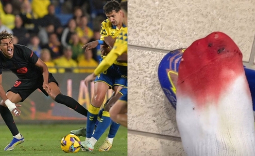 Sao trẻ hay nhất Barca đăng tải hình ảnh bàn chân rướm máu, lột tả công tác trọng tài La Liga
