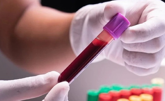 Chưa có bằng chứng khoa học về lọc máu có thể phòng ngừa các bệnh liên quan đến mỡ máu, đột quỵ