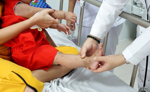 Hà Nội mở đợt cao điểm phòng chống bệnh tay chân miệng trong trường học