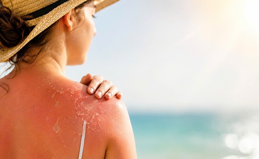 Cháy nắng: Cảnh báo tổn thương da trong mùa nắng nóng