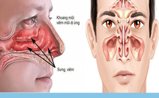 Thời tiết hè thất thường: Coi chừng nhầm lẫn giữa viêm mũi dị ứng và viêm xoang