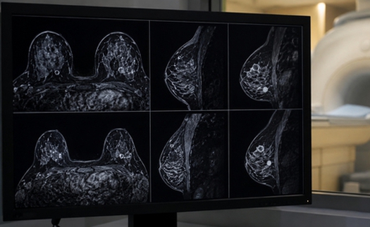 AI giúp tăng tốc chụp MRI phát hiện ung thư vú