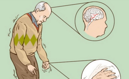 Các nhà khoa học Bỉ giải mã thành công bệnh Parkinson